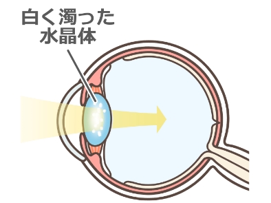 白内障の眼