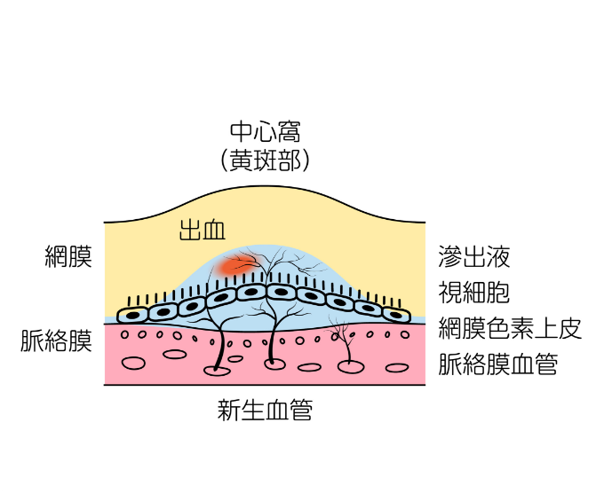 加齢黄斑変性の状態