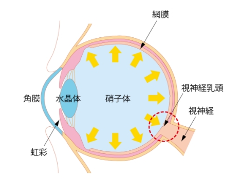 緑内障の眼
